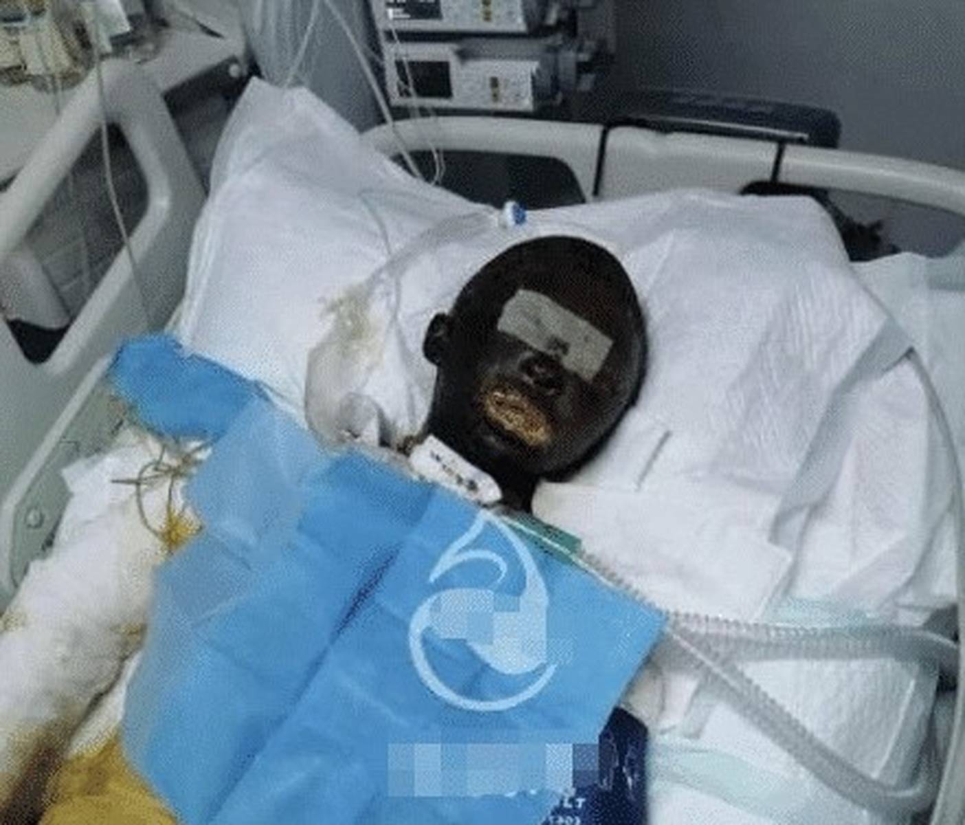 拉姆烧伤事件最新图片,悲剧背后的深度反思